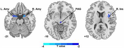 Dysregulation of Pain- and Emotion-Related Networks in Trigeminal Neuralgia